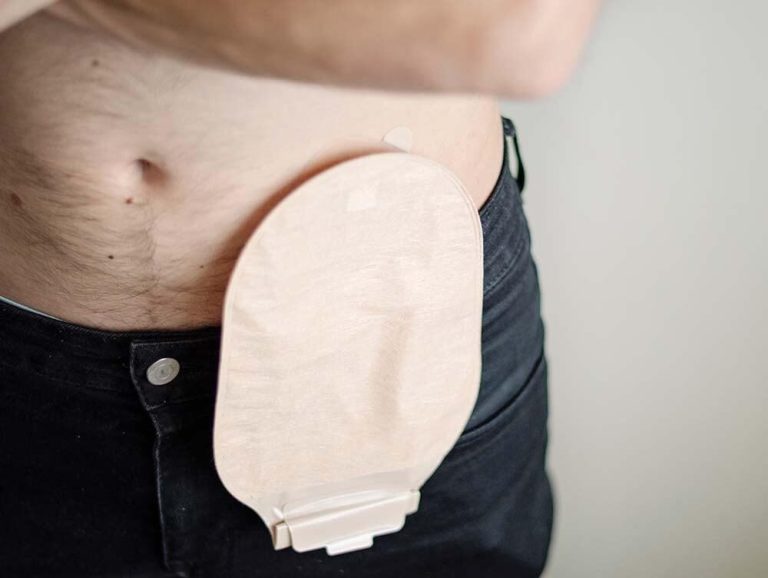 To stoma or not to stoma